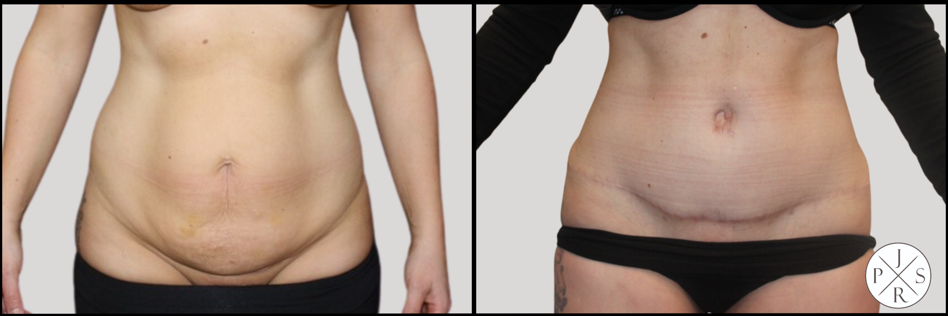 Abdominoplasty Before & After Image